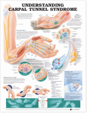 ANAT Chart, Understanding Carpal Tunnel Syndrome